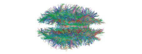 White matter connections in the brain, visualized by magnetic resonance imaging (MRI) tractography